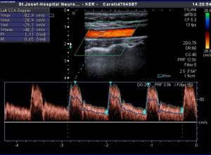 υπέρηχος εγκεφαλικών αγγείων2