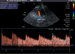 υπέρηχος εγκεφαλικών αγγείων3