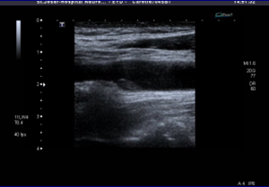 υπέρηχος εγκεφαλικών αγγείων4